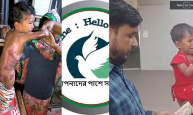 নওগাঁয় পুড়ে যাওয়া এক বাচ্চার সেবায় 