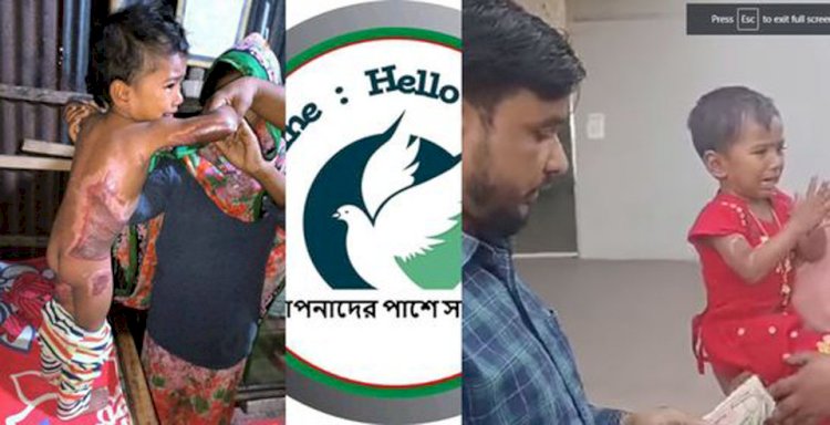 নওগাঁয় পুড়ে যাওয়া এক বাচ্চার সেবায় 